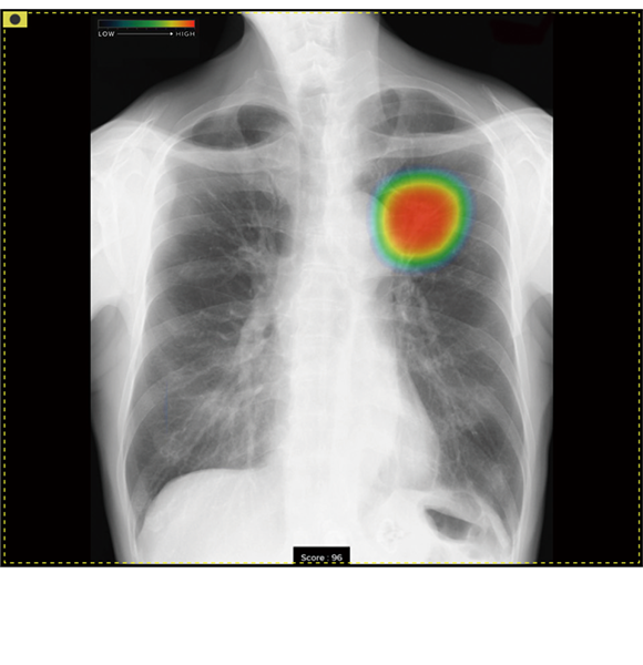 CXR-AID（胸部X線画像病変検出ソフトウェア）
